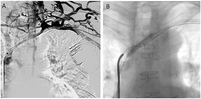 Are Endovascular Interventions for Central Vein Obstructions due to Cardiac Implanted Electronic Devices Effective?